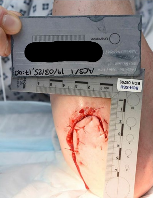 injury to PCs arm.jpg